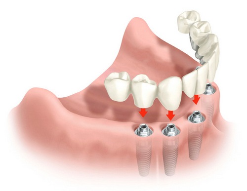 implant-vise-zuba-frontalno
