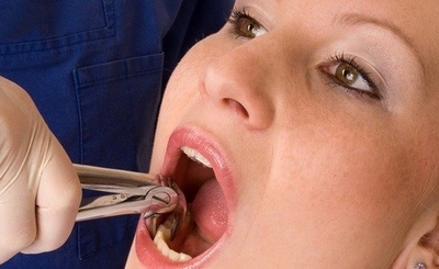 vadjenje zuba